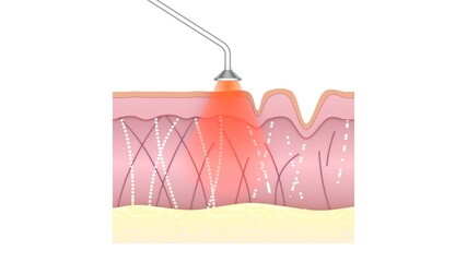 Laser skin treating. Innovation anti-aging therapy. Skin rejuvenation, wrinkle-smoothing, stimulating collagen production. Medical CG illustration.
