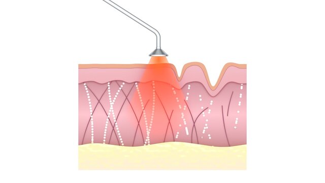 Laser skin treating. Innovation anti-aging therapy. Skin rejuvenation, wrinkle-smoothing, stimulating collagen production. Medical CG illustration.
