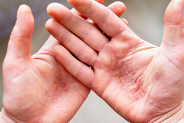 Man shows the psoriasis on his hands