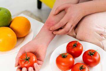 Cropped view of woman with allergy reaction holding tomato near fresh fruits