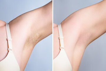 Young female with armpit hair. Before and after removal hair collage. Depilation concept.