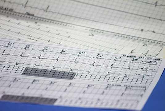 Tracing of electrocardiograms on graph paper. Records of heart activity. Heartbeat with arrhythmia. Selective focus