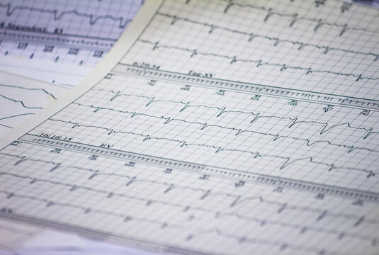Tracing of electrocardiograms on graph paper. Records of heart activity. Heartbeat with arrhythmia. Selective focus