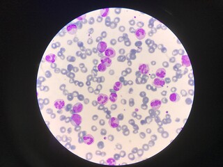 Immature and mature white blood cells.Segmented neutrophil,blast cells myelocyte,metamyelocyte,Band form in blood smear,