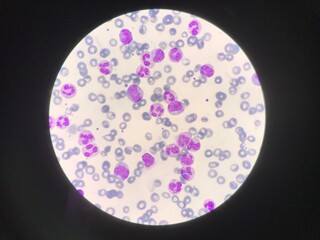 Immature and mature white blood cells.Segmented neutrophil,blast cells myelocyte,metamyelocyte,Band form in blood smear,