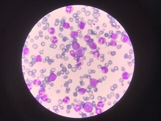 Immature and mature white blood cells.Segmented neutrophil,blast cells myelocyte,metamyelocyte,Band form in blood smear,
