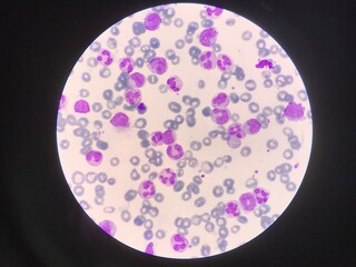Immature and mature white blood cells.Segmented neutrophil,blast cells myelocyte,metamyelocyte,Band form in blood smear,