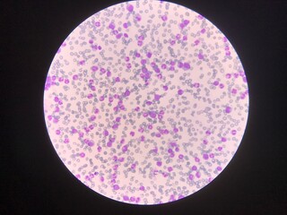Immature and mature white blood cells.Segmented neutrophil,blast cells myelocyte,metamyelocyte,Band form in blood smear,