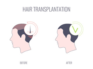 Hair transplantation procedure. Hair loss medical treatment of a female patient with alopecia. Faceless woman, no identity concept. Before and after concept. Vector linear illustration.