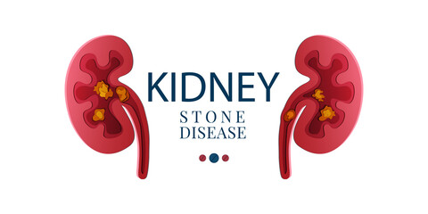 Kidney stone disease awareness poster with kidneys made in 3D paper cut craft style on white background. Renal stones. Medical solidarity concept. Human body organ anatomy icon. Vector illustration.