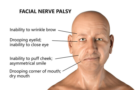 Facial nerve paralysis