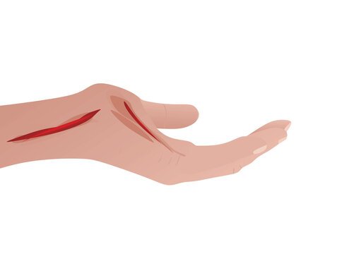 hand with red cuts, injury, medical clip art preview