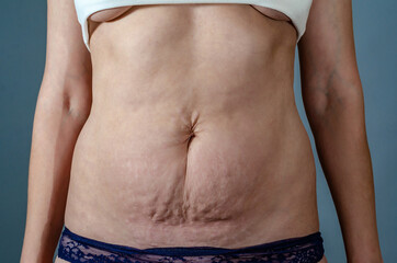 Stretch marks on woman abdomen after childbirth. Deep scars, damaged skin