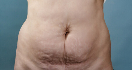Naklejka premium Close-up of female abdomen with loose skin, stretch marks and excess skin after significant weight loss or pregnancy. Medical body concept for plastic surgery, skin tightening and postpartum care.