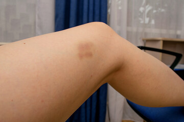 Yellow bruise on a woman's left leg from a blow