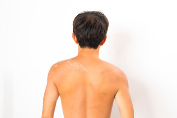Fototapeta na wymiar Asian man with sunburned skin and face on white background.