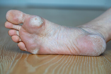 Image for medical purposes. Dry skin, plantar callosity and flakes on the female feet sole close up.