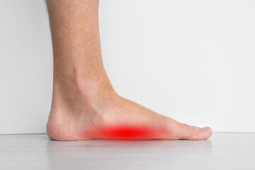 Foot pain because of strong flat feet also called pes planus or fallen arches. The arches on the...