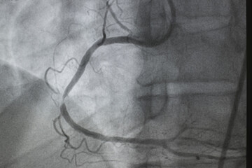 Coronary angiogram , medical x-ray for heart disease. Coronary artery disease.