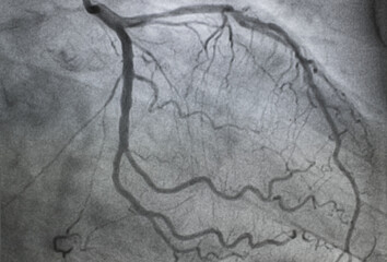 Coronary angiogram , medical x-ray for heart disease. Coronary artery disease.