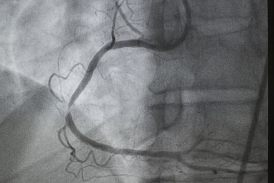 Coronary angiogram , medical x-ray for heart disease. Coronary artery disease.