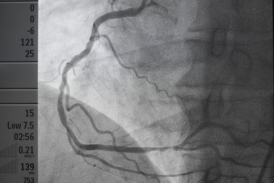 Coronary angiogram , medical x-ray for heart disease. Coronary artery disease.
