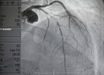 Coronary angiogram , medical x-ray for heart disease. Coronary artery disease.