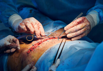 Close up of plastic surgeon hands in sterile gloves placing sutures after tummy tuck surgery in...