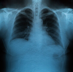X-ray film of the lungs