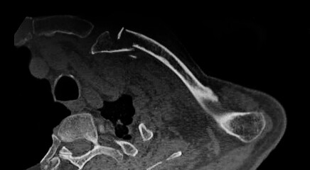 Rx image of left clavicle fracture