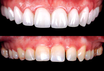 Perfect smile before and after bleaching procedure whitening of zircon arch ceramic prothesis...