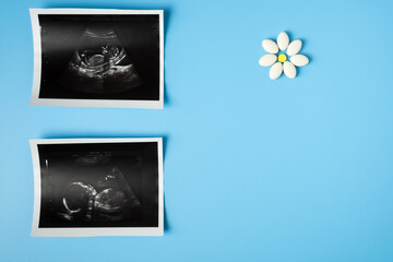 Prenatal vitamins, supplements and medications for healthy pregnancy. Baby in mother womb during ultrasound examination. Pills of Folic acid and multivitamins on blue background with copy space.