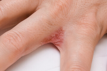 Hand with interdigital dermatitis, dyshidrotic eczema on hand close up