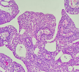Photo of conjunctival papilloma, showing squamous epithelium with scattered goblet cell, magnification 200x, photo under microscope