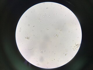 Fungus infection show budding yeast cells and pheudohyphae in urine.