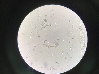 White blood cells clumping in Urinary tract infection.
