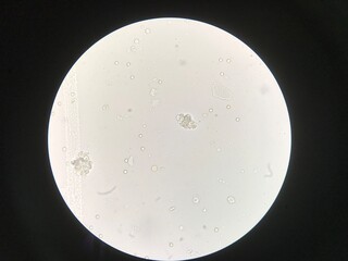 White blood cells clumping in Urinary tract infection.