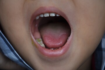 boys mouth with food in teeth