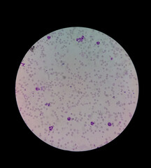 Microscopic view of hematology slide. RBC. WBC. closeup. Stained slide. Smear. Platelet, blood film