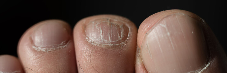 Close-up of male toes with a cracked nail