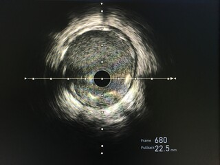 Intravascular ultrasound imaging (IVUS) at cardiac catheterization laboratory room.