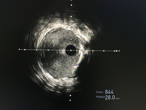 Intravascular ultrasound imaging (IVUS) at cardiac catheterization laboratory room.