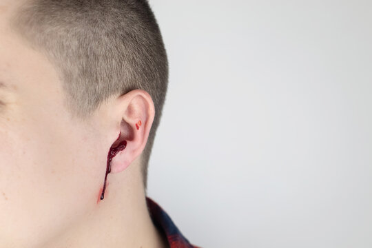 A man whose ear is bleeding. Vascular rupture, damage to the tympanic membrane, ear diseases, oncology, otitis media, myringitis