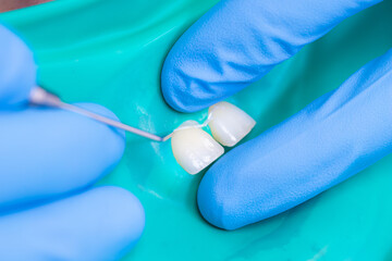 Dentistry, patient teeth close-up on a protective latex napkin. Dentist in blue gloves treats teeth