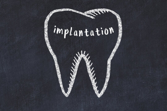 Chalk drawing of a tooth with medical term implantation. Concept of learning stomatology