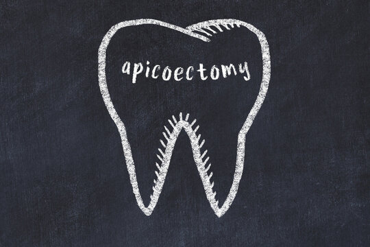 Chalk drawing of a tooth with medical term apicoectomy. Concept of learning stomatology