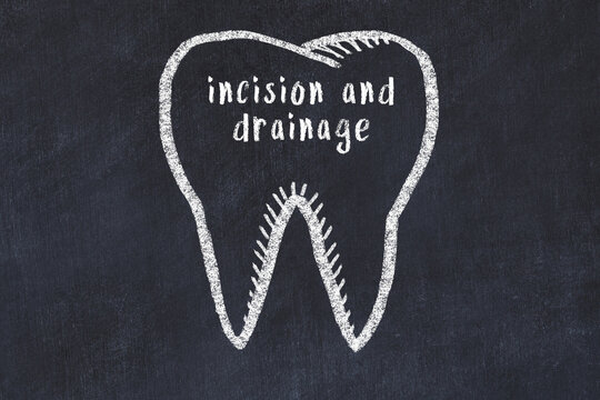 Chalk Drawing Of A Tooth With Medical Term Incision And Drainage. Concept Of Learning Stomatology