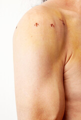 Naklejka premium Male shoulder with scars after shoulder Arthroscope surgery. Chronic dislocation of the long biceps tendon after surgery. Reconstruction of the cranial third of the SSC tendon corkscrew anchor. Wound 