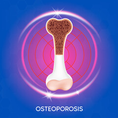 Realistic 3d bone Medical  bone- osteoporosis. Medical or healthcare concept. bone protection.