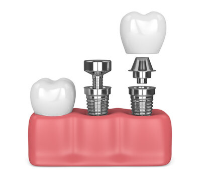 3d render of gums with implanting tooth procedure